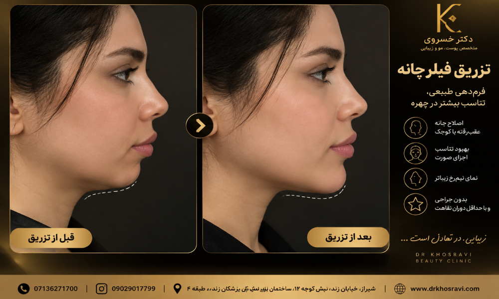 عکس فیلر چانه