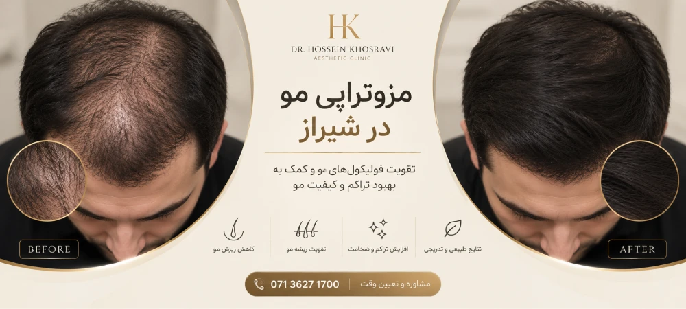 مزوتراپی در شیراز