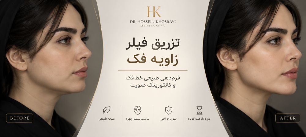 فیلر زاویه فک در شیراز