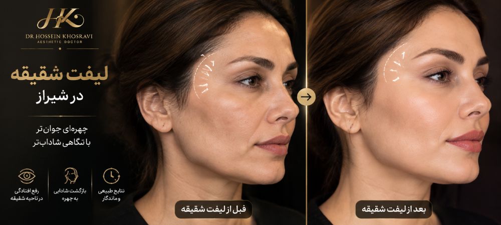 تزریق فیلر شقیه در شیراز